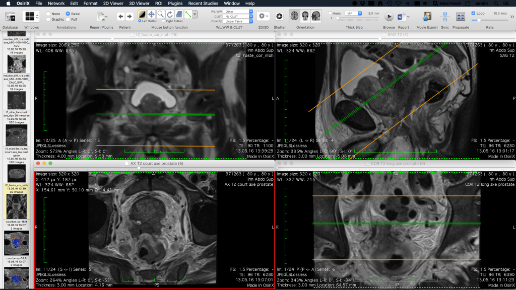 OsiriX MD — interfejs przeglądarki DICOM
